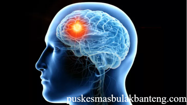 Mengenal Tumor Otak: Informasi Penting untuk Pembaca Umum